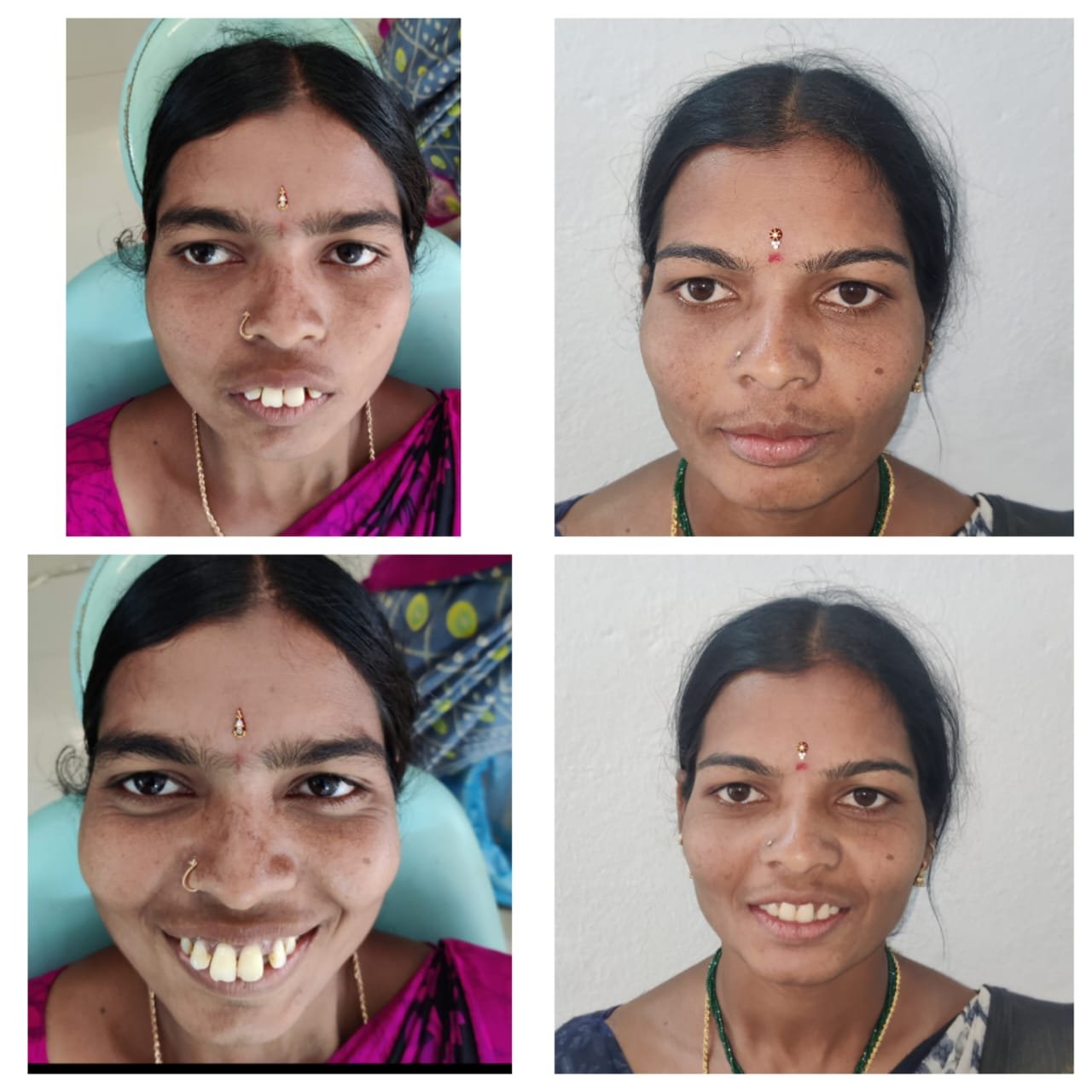 Smile Transformation — Before & After at SRDH Tukkuguda