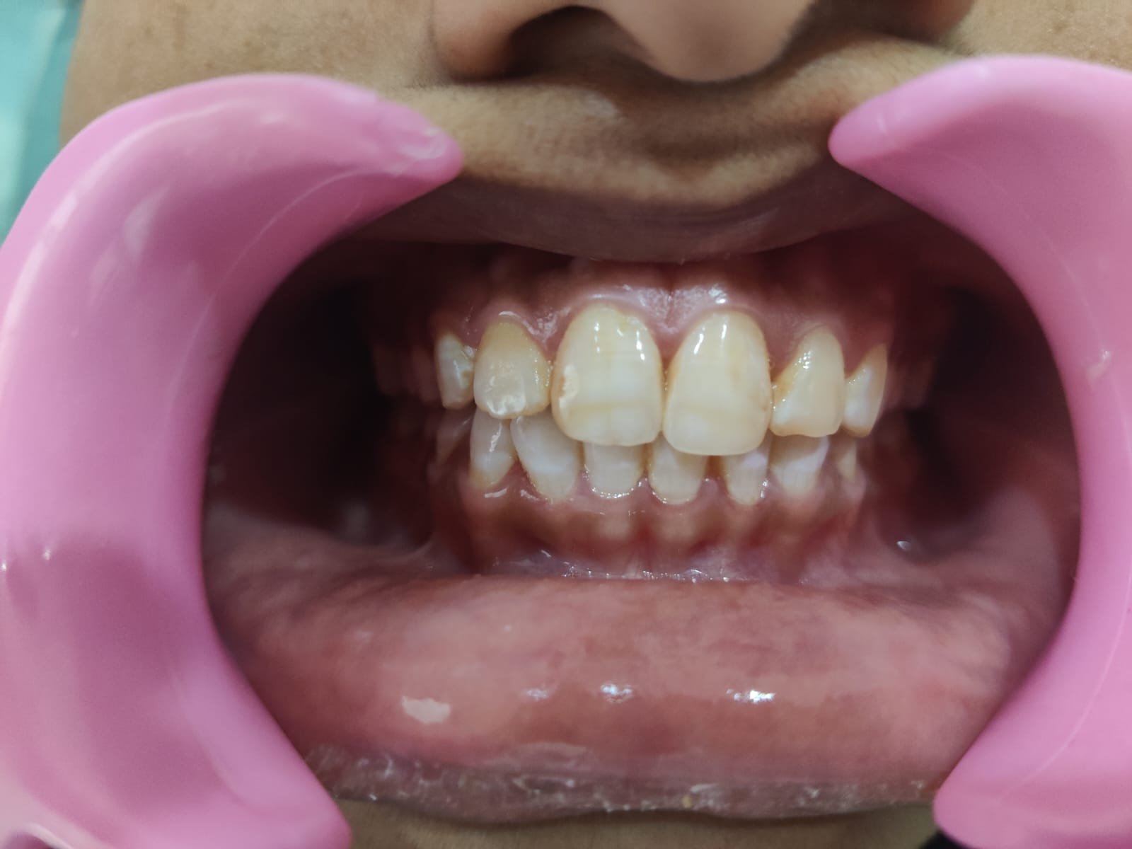 Dental Examination — Teeth Close-up at Sri Ramachandra Dental Hospital