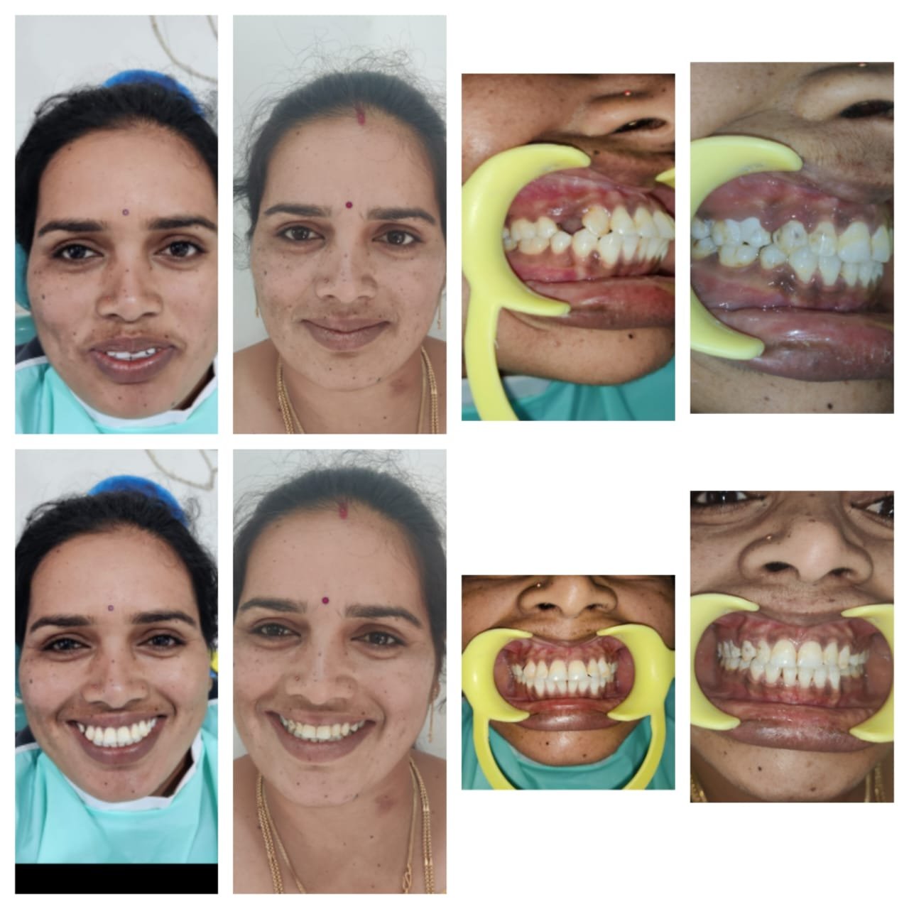 Full Case — Face & Teeth Before & After at SRDH Tukkuguda