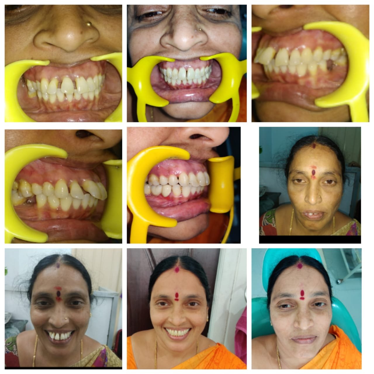 Dental Restoration Journey at SRDH Tukkuguda