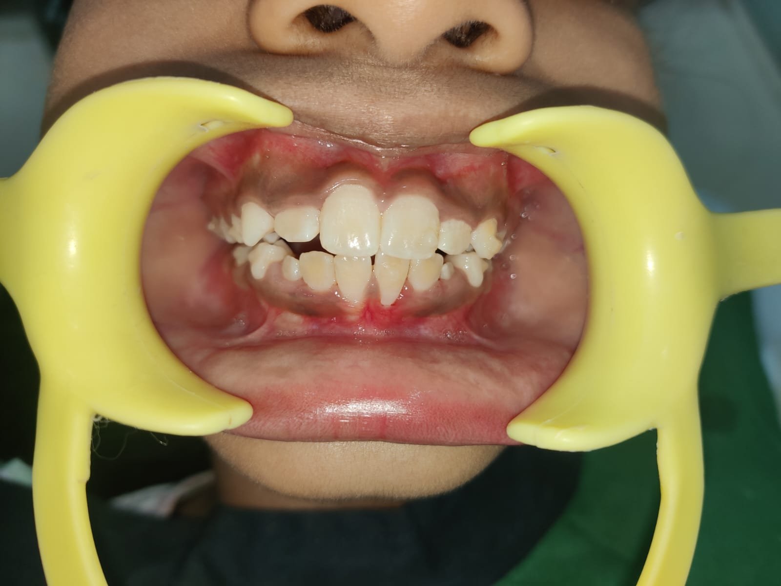 Malocclusion Evaluation at Sri Ramachandra Dental Hospital