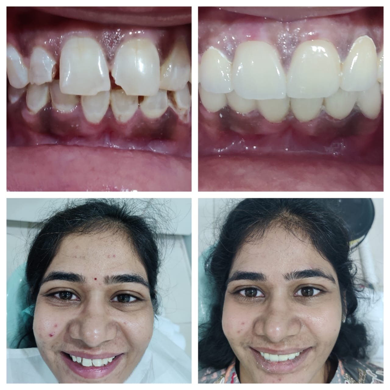 Gap Closure — Before & After at SRDH Tukkuguda