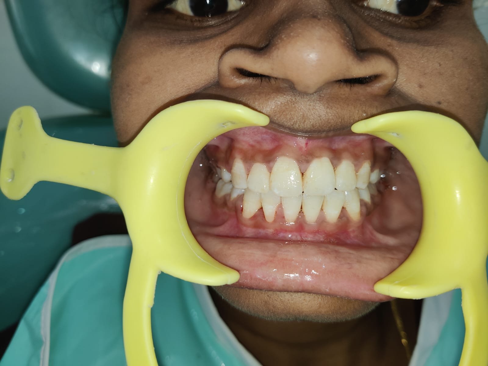Clinical Teeth Examination at Sri Ramachandra Dental Hospital