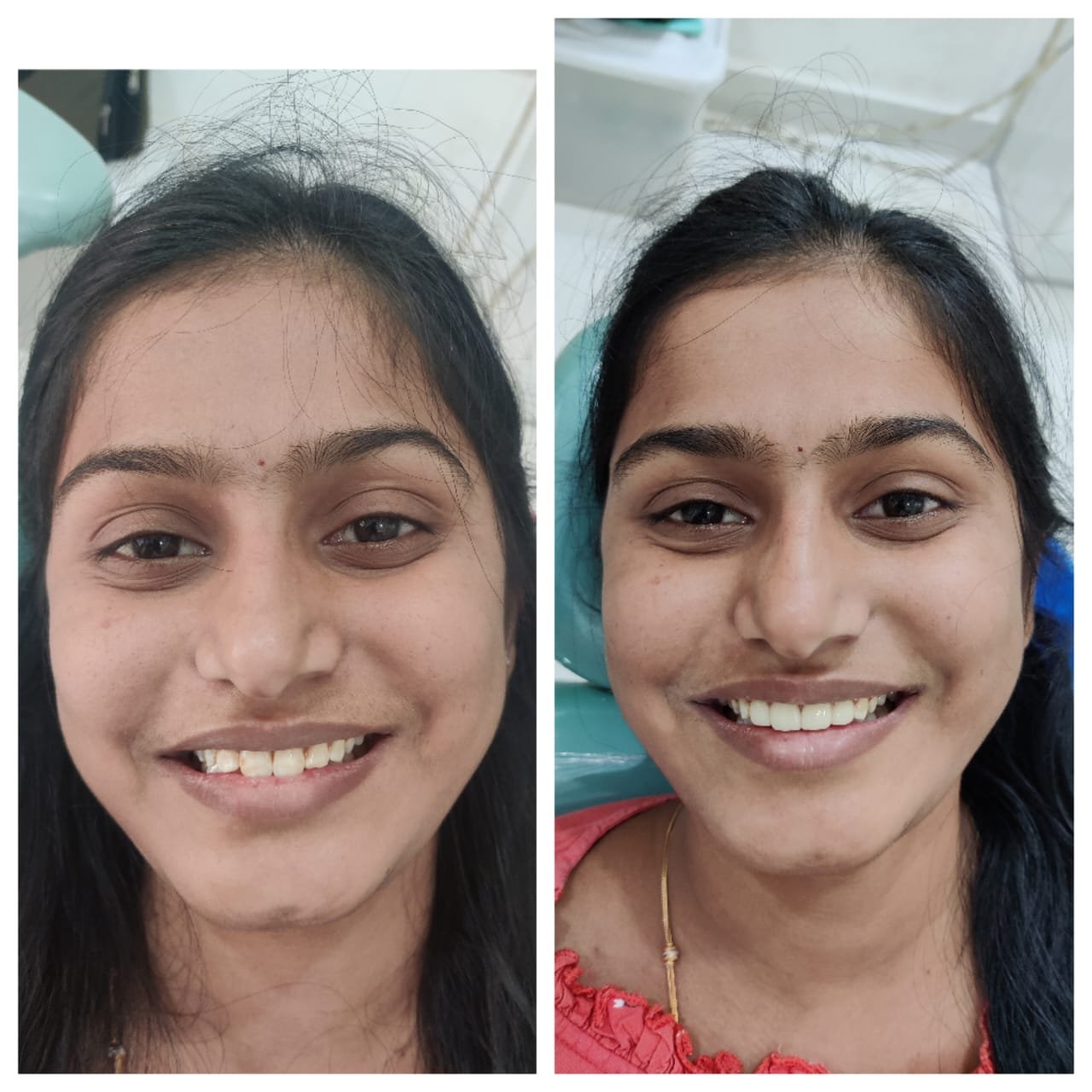 Smile Makeover — Before & After at SRDH Tukkuguda