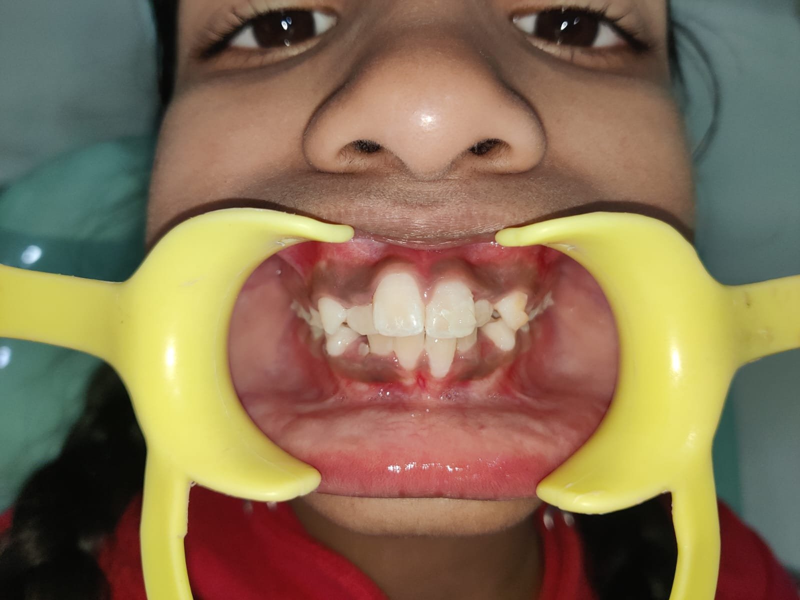 Crowded Teeth Assessment at Sri Ramachandra Dental Hospital