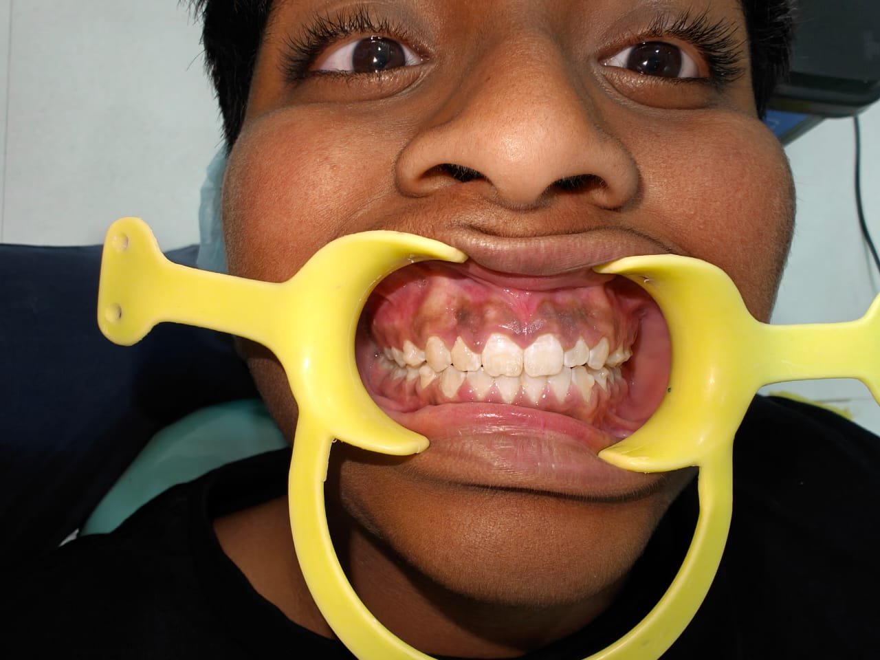 Orthodontic Case Evaluation at Sri Ramachandra Dental Hospital