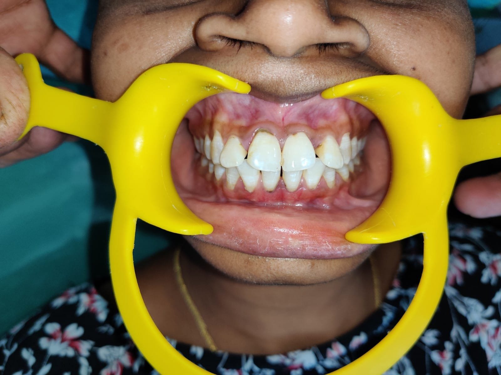 Bite Analysis at Sri Ramachandra Dental Hospital
