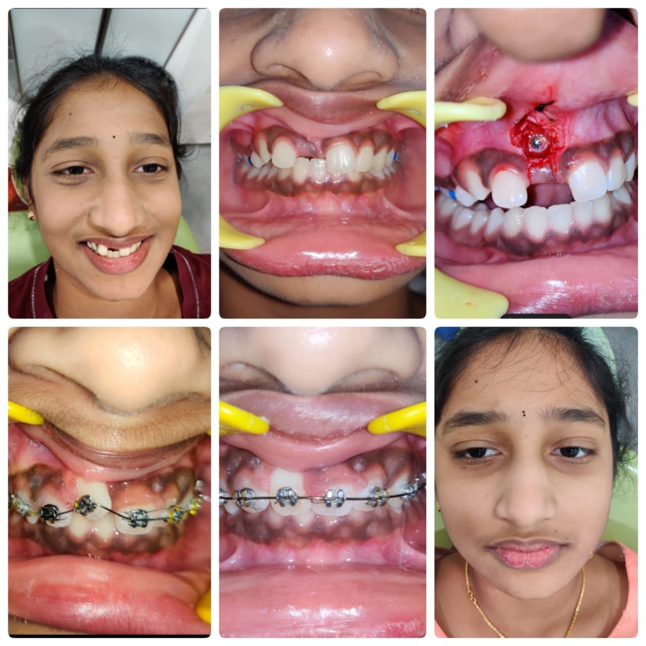Orthodontic Braces Journey at SRDH Tukkuguda