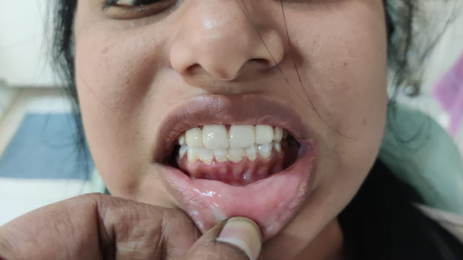 Post-Treatment Teeth Alignment at Sri Ramachandra Dental Hospital