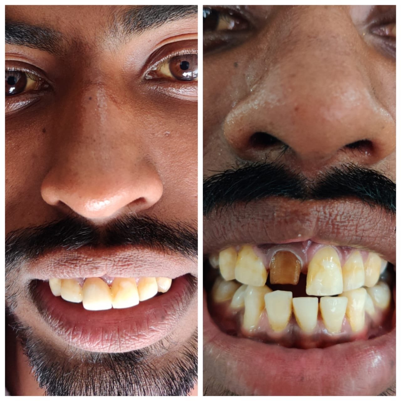Teeth Repair — Before & After at SRDH Tukkuguda