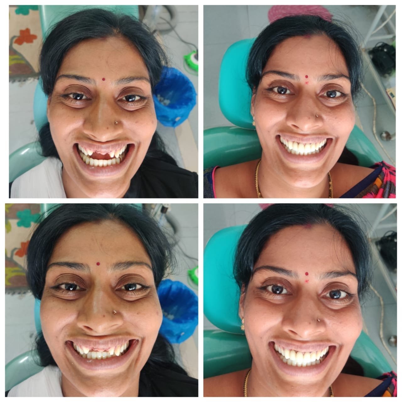 Missing Teeth Restored — Before & After at SRDH Tukkuguda